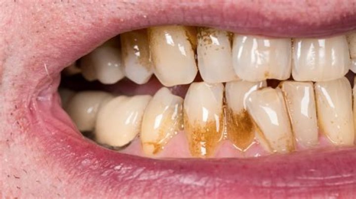 How do I get rid of black stains between my teeth?