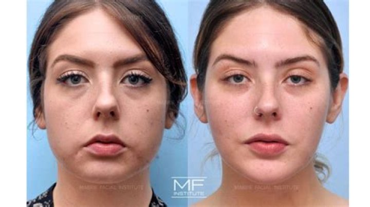 How do I get rid of jowls around my mouth?