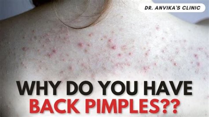 How do I prevent pimples on my back and shoulders?