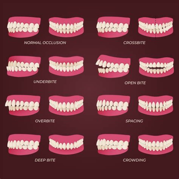 How do you fix a malocclusion tooth?