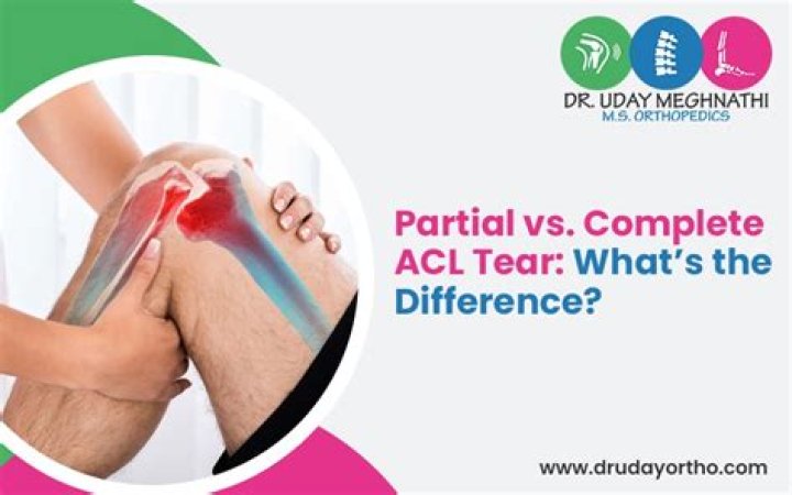 How do you fix a partial ACL tear?