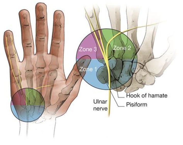 How do you fix ulnar drift?