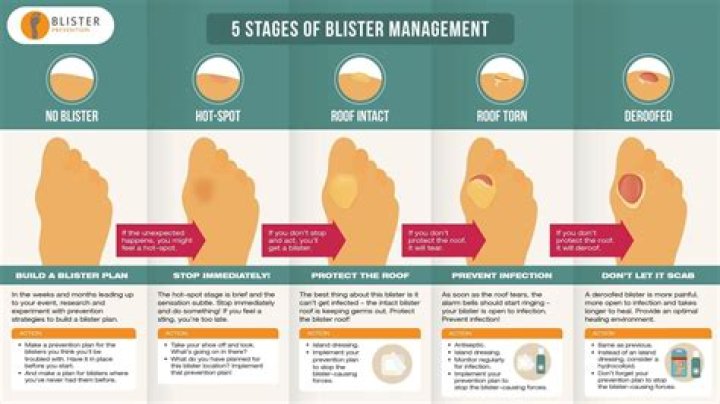 How do you get rid of a pressure blister on a piercing?