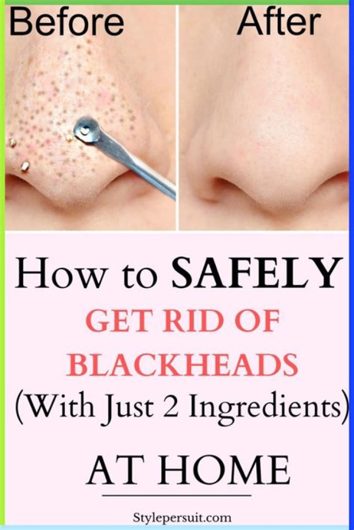 How do you get rid of bad blackheads?