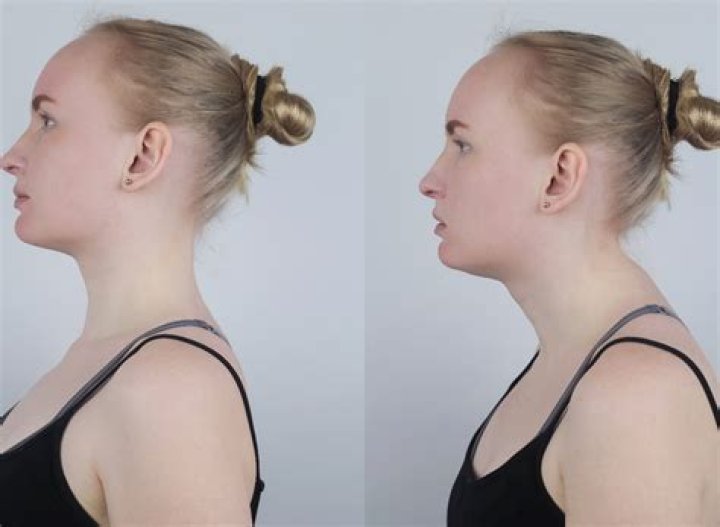 How do you get rid of neck muscle?