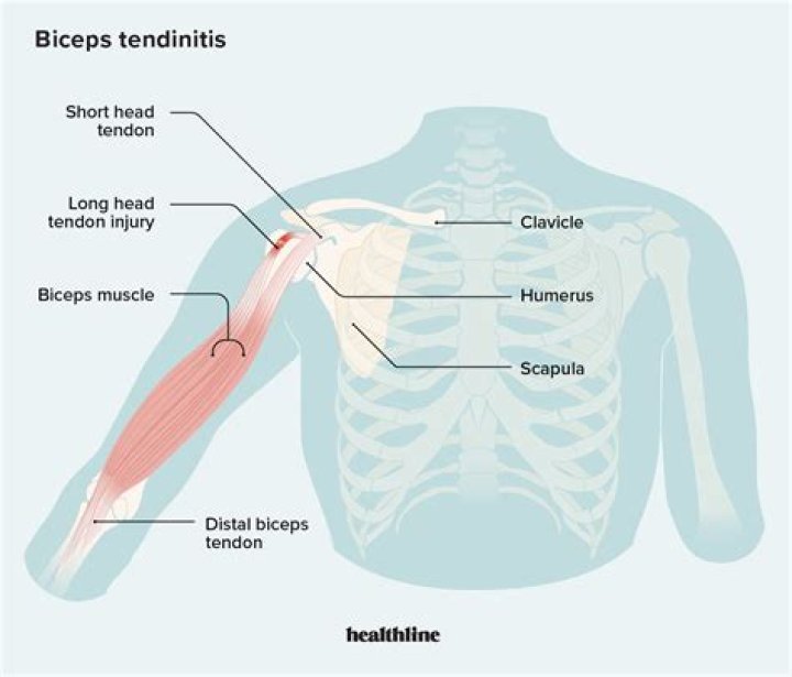 How do you get rid of sore biceps?
