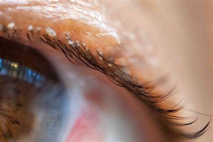 How do you know if you have eyebrow mites?