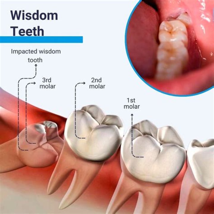 How do you know if your wisdom tooth is sideways?