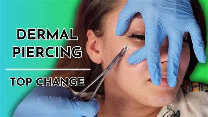 How do you remove a dermal anchor yourself?