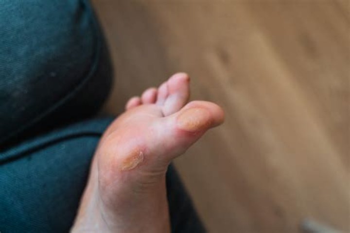 How do you treat a blister under a callus?