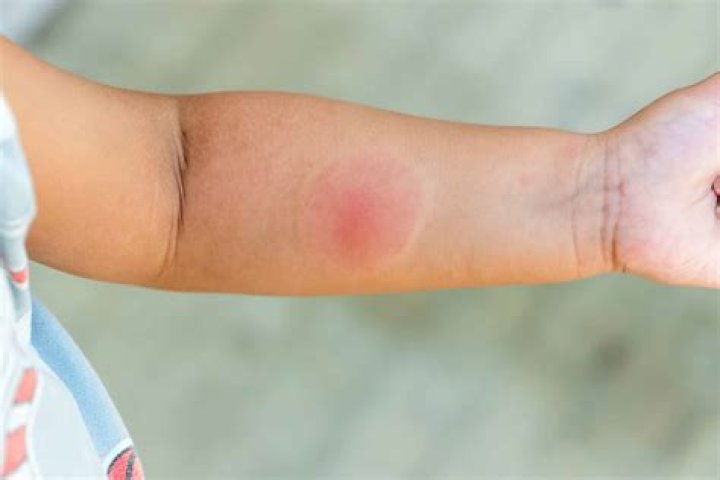 How do you treat a cheek bite?