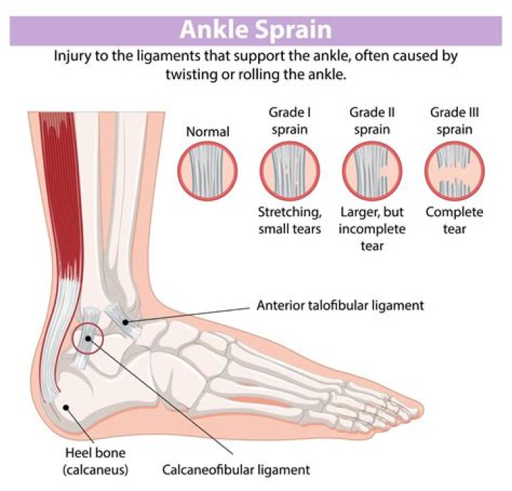 How do you treat a Grade 2 ankle sprain?