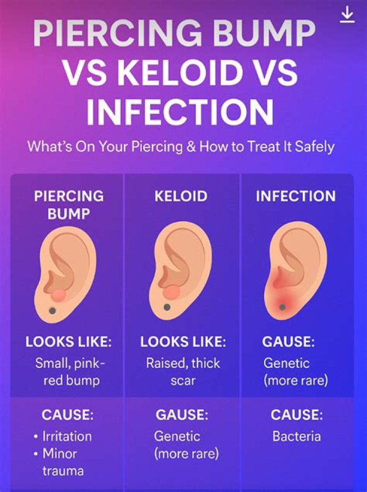 How do you treat a keloid on an industrial piercing?