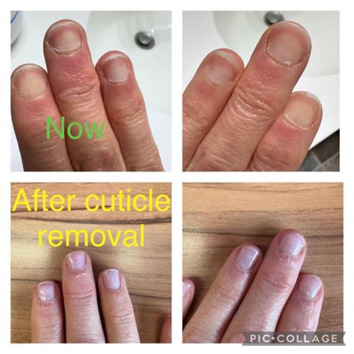 How do you treat damaged cuticles?