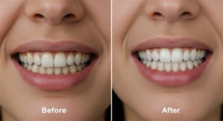 How do you use gel teeth whitening?