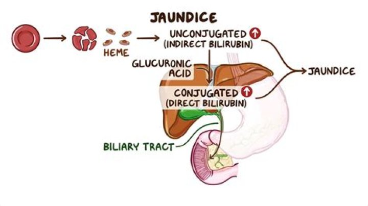 How does hepatitis cause jaundice?