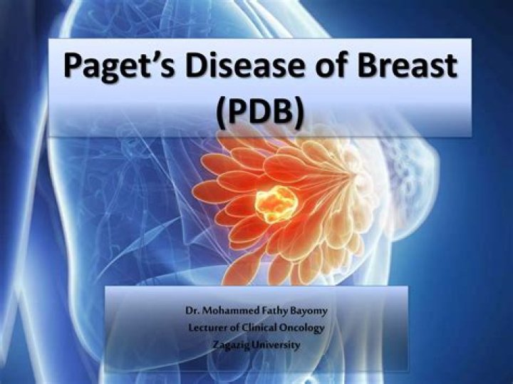 How is Paget's disease of the breast diagnosed?