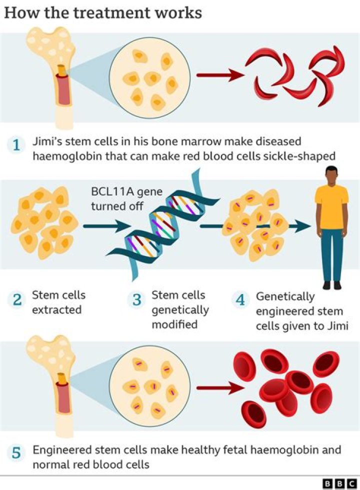 How is sickle cell anemia passed on genetically?