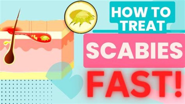 How long after treatment for scabies are you contagious?