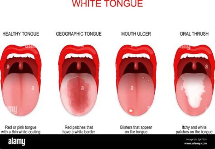 How long do ulcers last on the tongue?