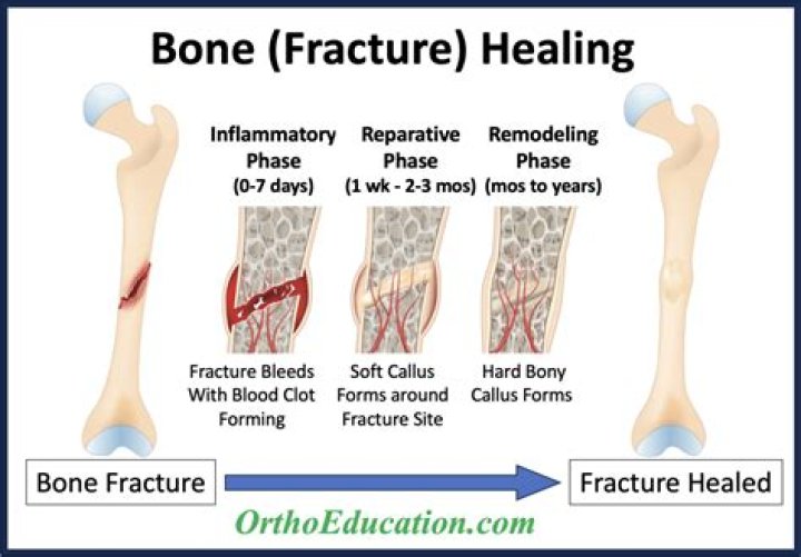 How long does a trapezium fracture take to heal?