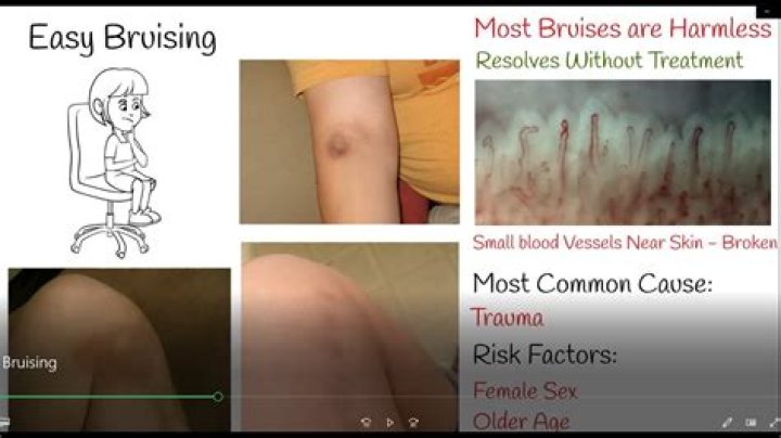 How long does bruising on the brain take to heal?