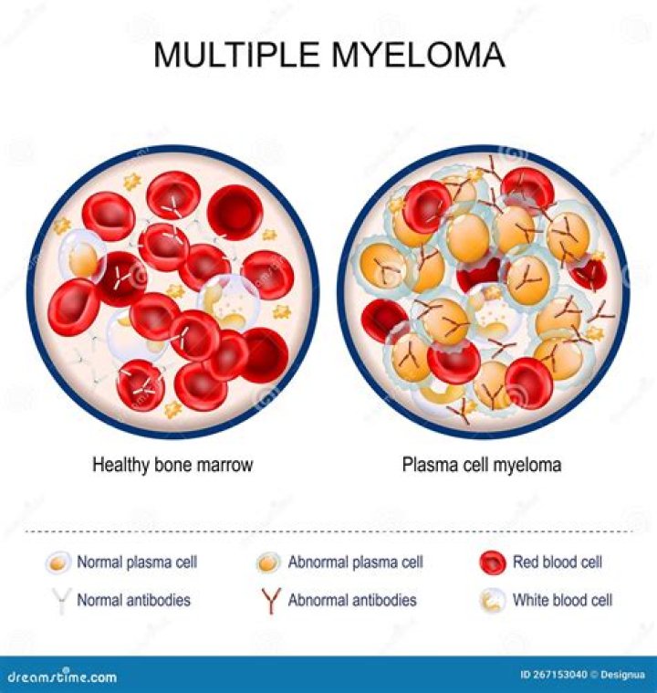 How long does multiple myeloma take to develop?
