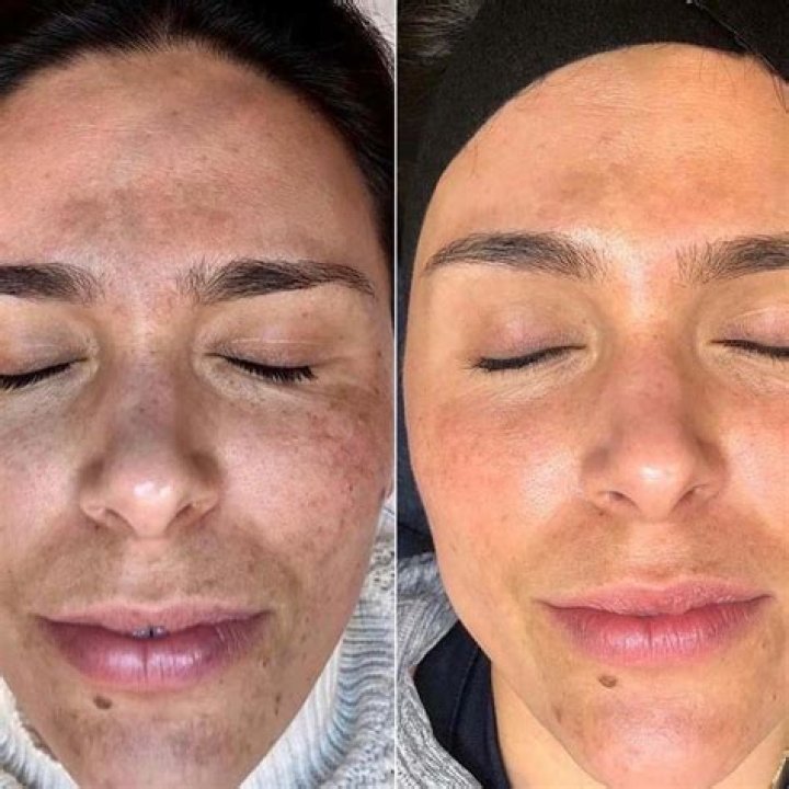 How long does TCA peel last?