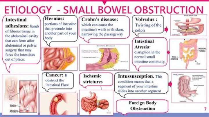 How many colonics should you have?