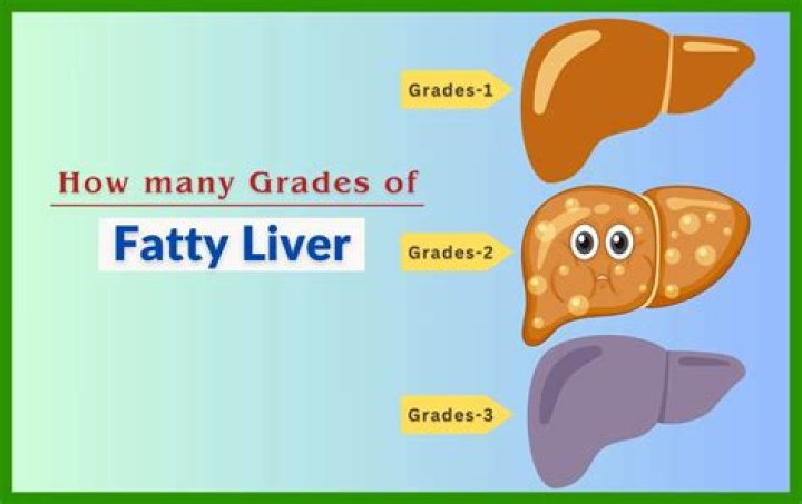 How many grades of fatty liver are there?