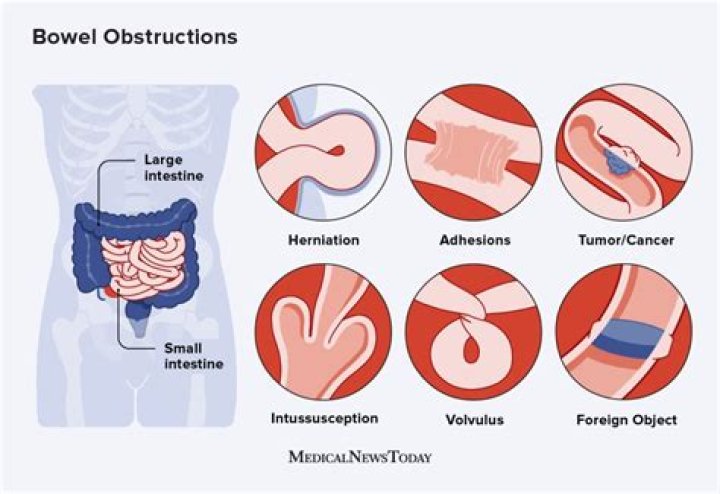 How much does bowel surgery cost?