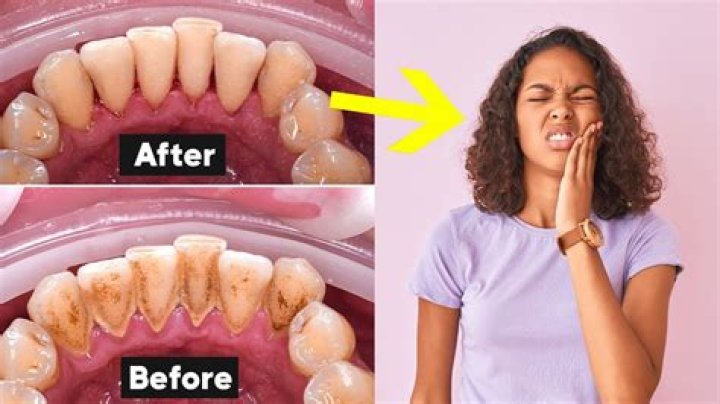 How much does it cost for teeth cleaning?