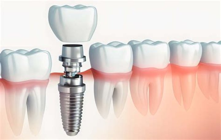 How much does it cost to get a tooth implant with insurance?