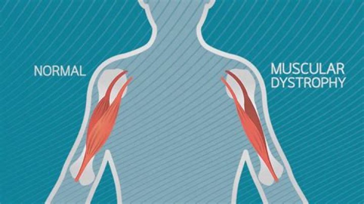 Is CMT a form of muscular dystrophy?