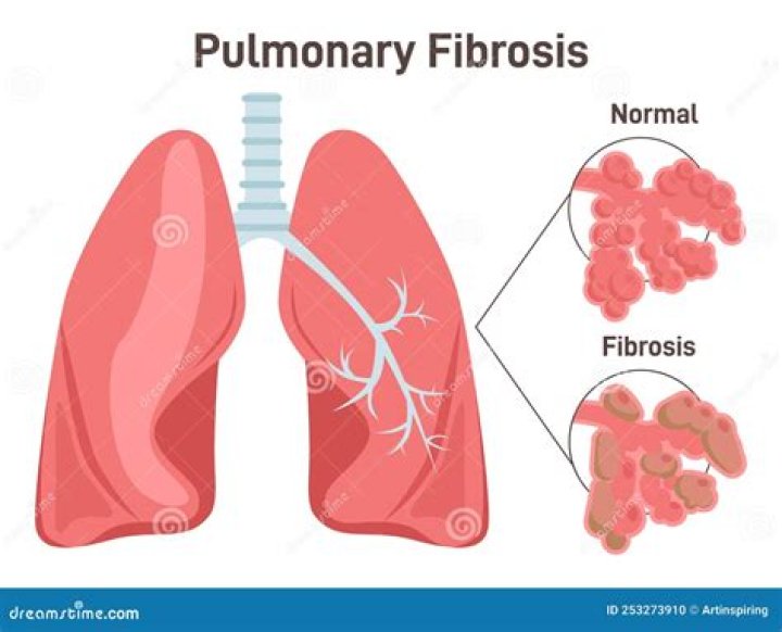 Is cystic fibrosis always fatal?