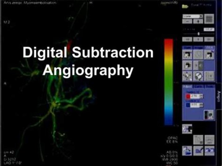Is digital subtraction angiography invasive?