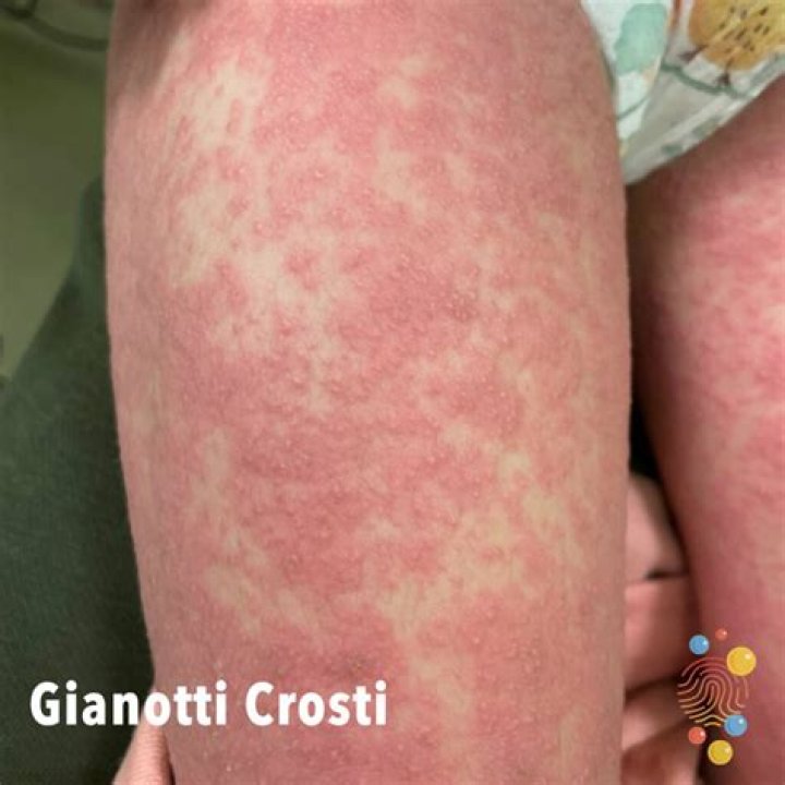 Is Gianotti crosti rash contagious?