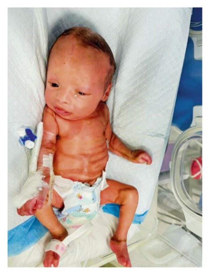 Is Harlequin ichthyosis fatal?