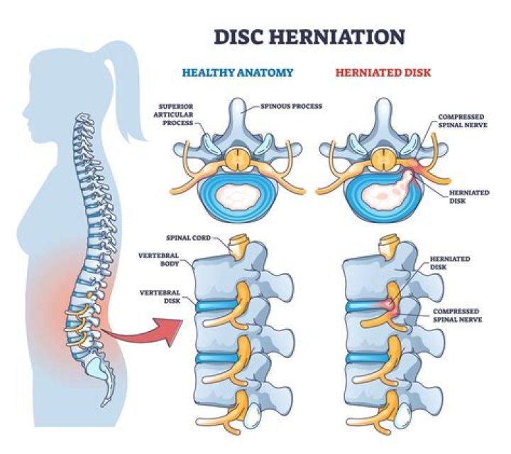 Is it OK to run with a herniated disc?