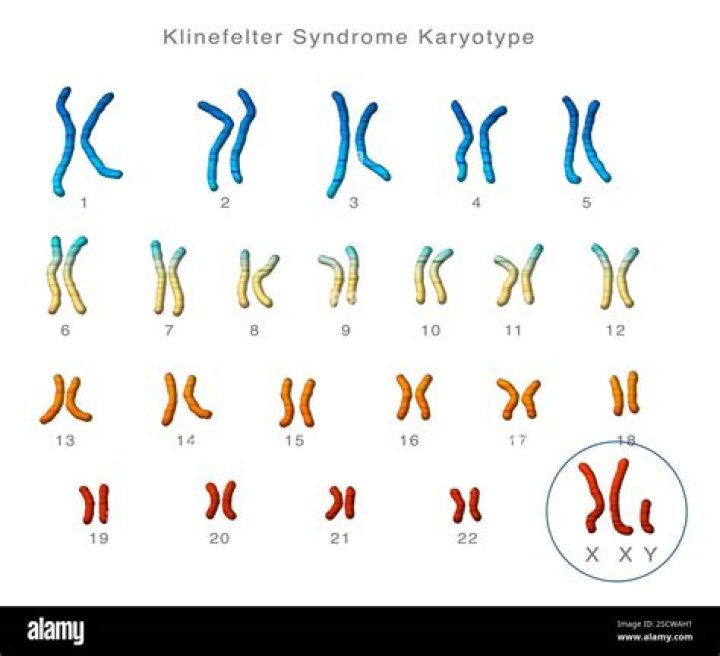 Is Klinefelter syndrome caused by Nondisjunction?