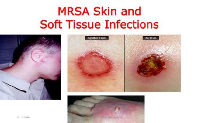 Is MSSA normal skin flora?