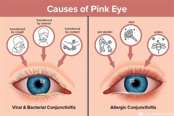 Is pink eye caused by feces?