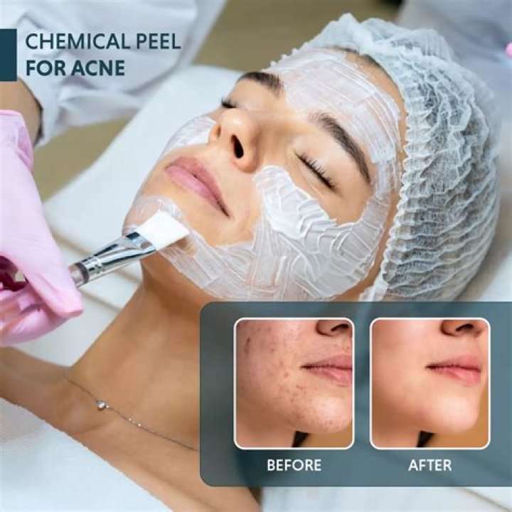 Is skin peeling after sunburn good?