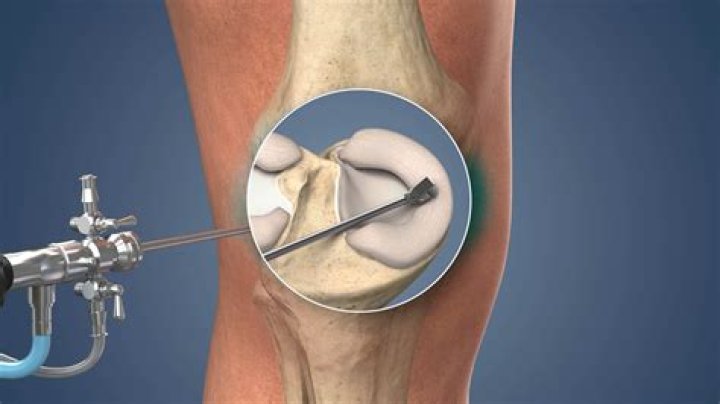Is surgery for a torn meniscus necessary?