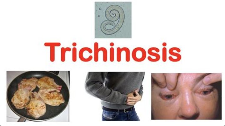 Is there a cure for trichinosis?