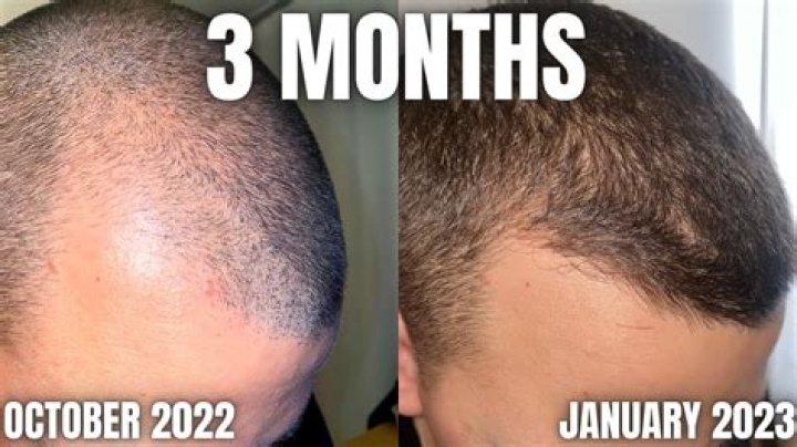 Should I shave when using minoxidil?