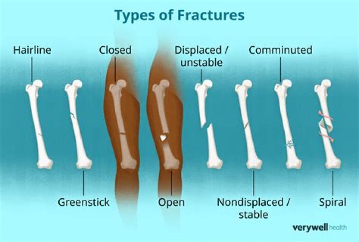 What's the least painful bone to break?