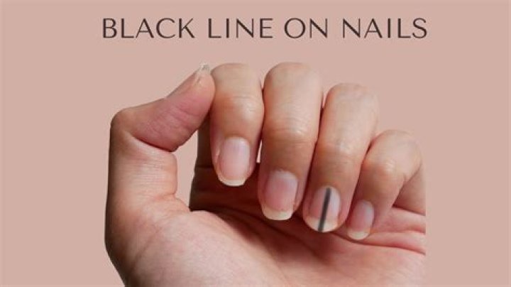 What are the brown lines on my nails?