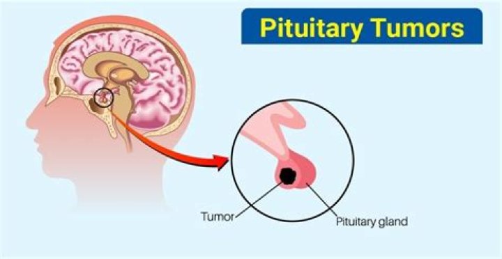 What are the symptoms of a tumor on your pituitary gland?