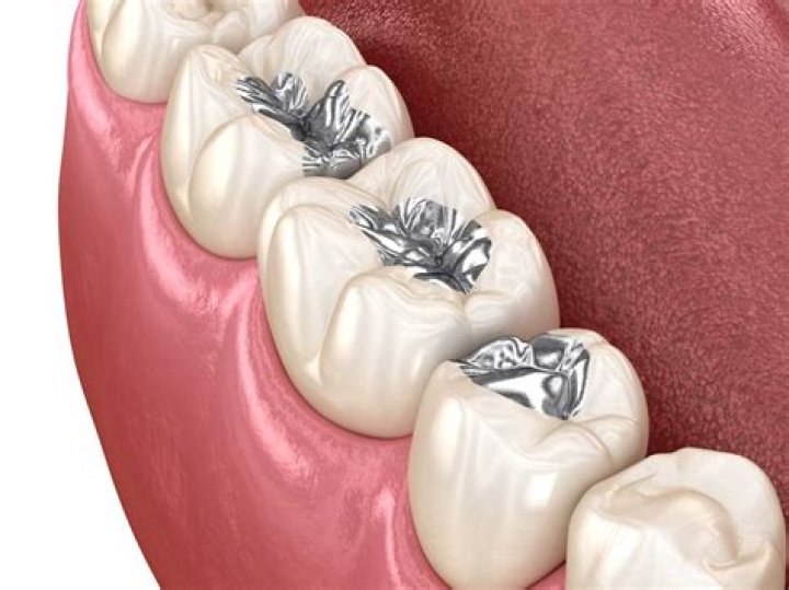 What are Venlay restorations?